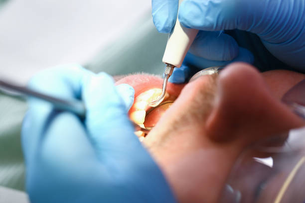Best Emergency Treatment for Dental Infections or Abscesses in Vinton, TX
