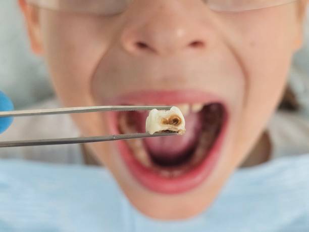 Best Emergency Tooth Extraction in Vinton, TX