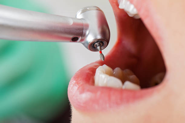 Best Emergency Root Canal Treatment in Vinton, TX